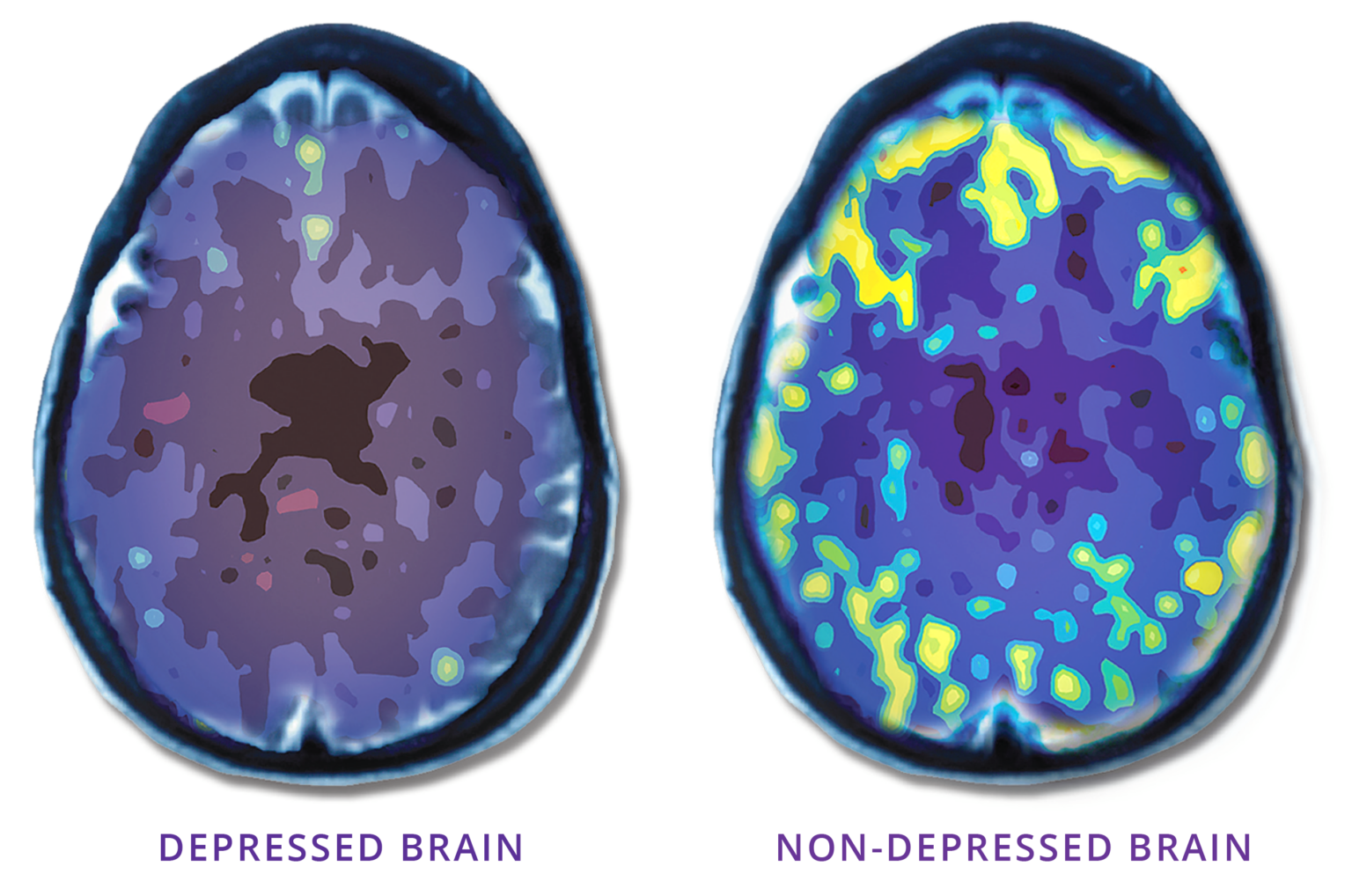 TMS Therapy for Major Depression in Virginia, Maryland & D.C.